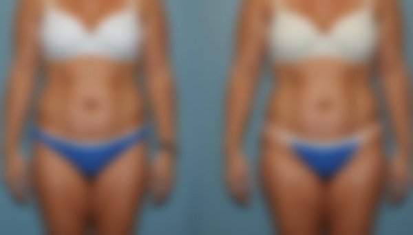 Liposuccion à marseille : embellissez votre corps sans cicatrices